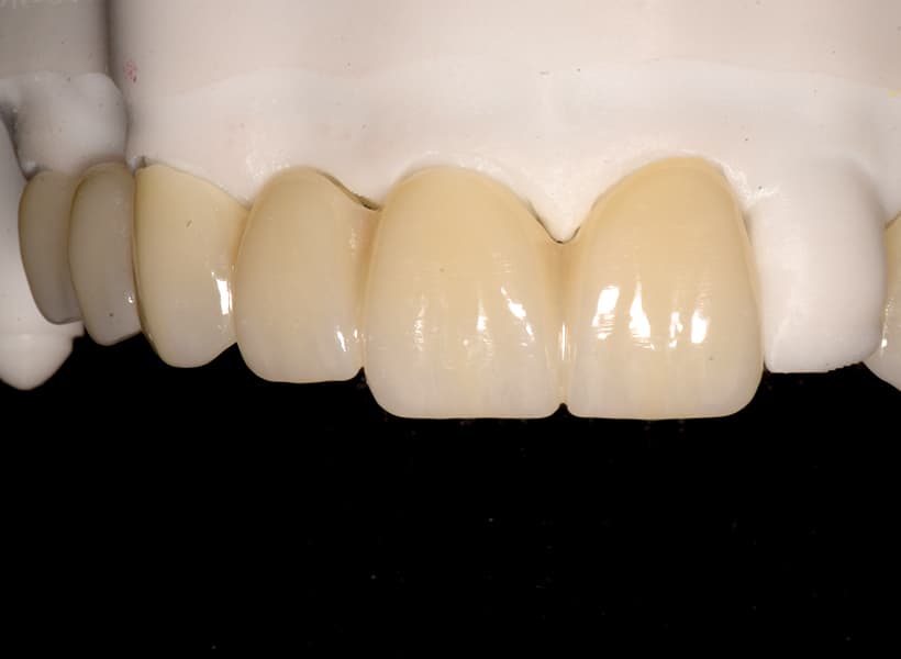 Caso 3 - Zirconio Anterior - Vista Frontal